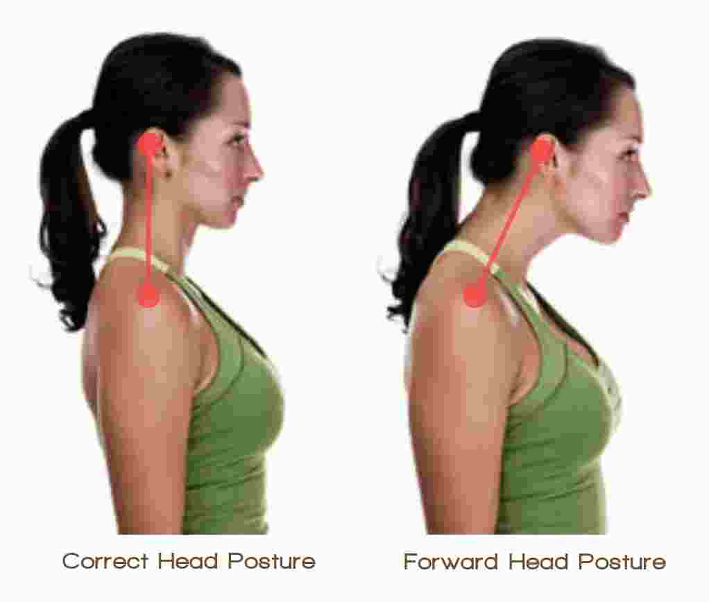 Forward Head Posture - Len Academy